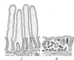região do intestino delgado em um indivíduo normal e em um indivíduo com doença celíaca