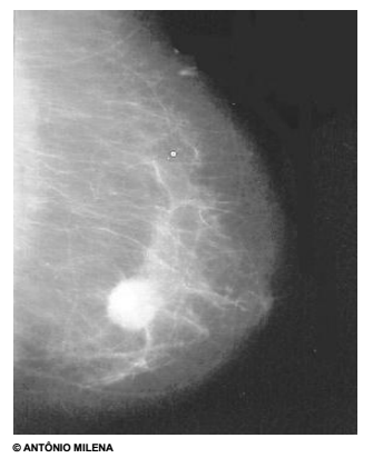 Radiografia de um câncer de mama